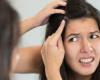 5 علاجات منزلية للوقاية من ظهور قشرة الرأس